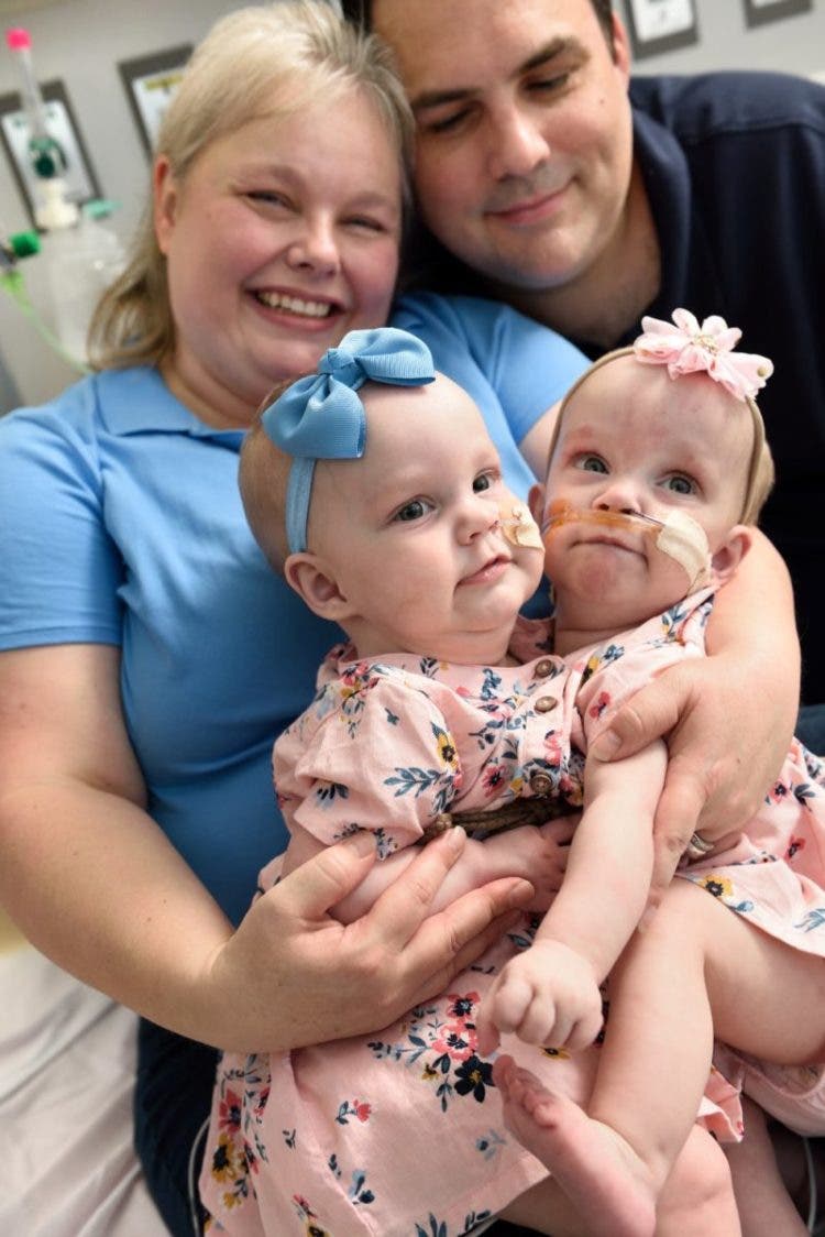 Jill Richards madre gemelas conjuntas ana grace hope elizabeth separadas Dr. Oluyinka Olutoye, Texas Children’s Hospital,