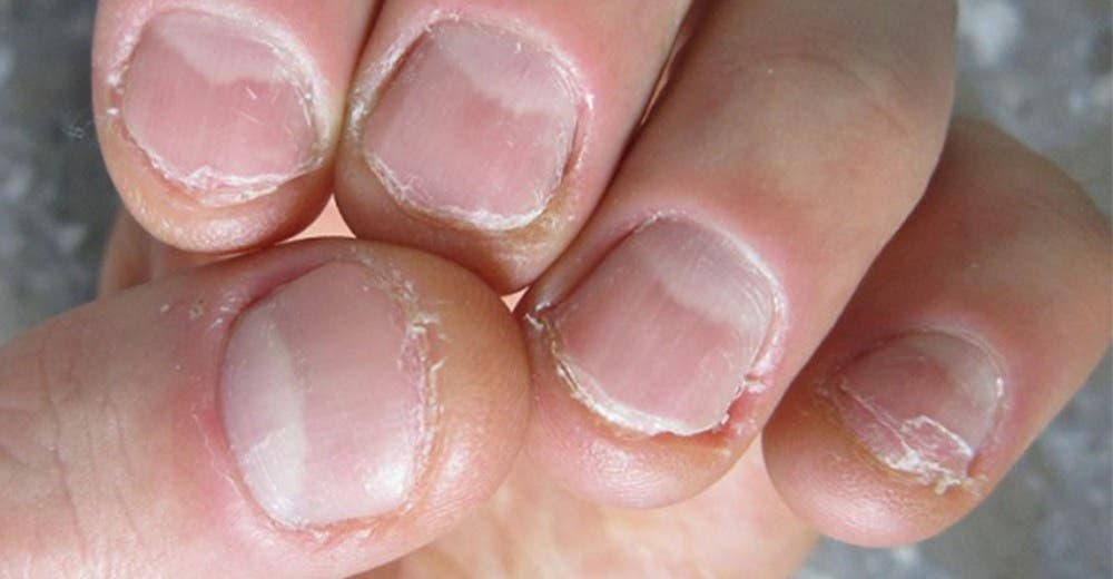 El «inofensivo» hábito de morderse las uñas casi le cuesta la vida a un hombre de 28 años