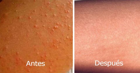 Prueba estos 5 tratamientos sencillos y naturales para eliminar los granitos de tu piel