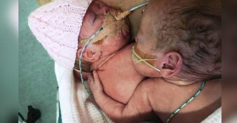 Su bebé abraza a su hermanita gemela a punto de morir – «Sabía que estaba muy mal»
