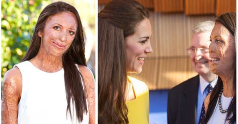 El encuentro entre Kate Middleton y la modelo que sobrevivió a horribles quemaduras