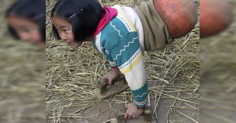 El drama de la niña que perdió sus piernas a los 4 años y usa una pelota para desplazarse