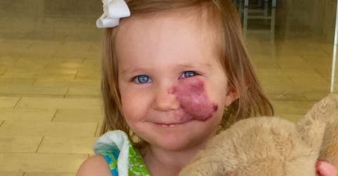 Una niña de 2 años responde a quienes susurraron sobre la marca de su rostro