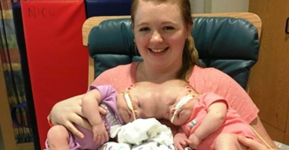 Las mellizas unidas por la cabeza por fin se van a casa a dormir en camas separadas Las mellizas unidas por la cabeza por fin se van a casa a dormir en camas separadas