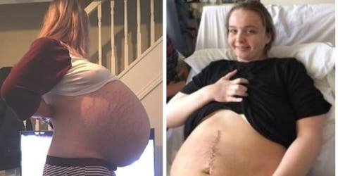 Los médicos comprueban que tenía un tumor de 26 Kilos tras creer que estaba embarazada