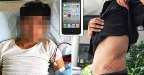 Un joven vende su riñón para comprarse un iphone y termina con una discapacidad de por vida