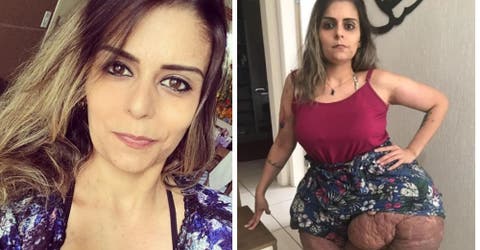 Sus piernas duplicaron su tamaño y cada 3 años debe someterse a una operación