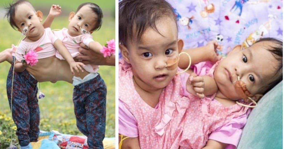 Las siamesas unidas por el abdomen son operadas pero se niegan a separarse Las siamesas unidas por el abdomen son operadas pero se niegan a separarse