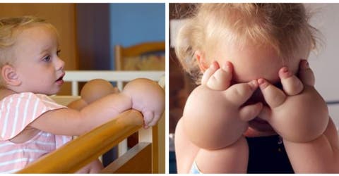 Una niña de 2 años es sometida a una liposucción para reducir la severa inflamación de sus manos