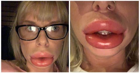 Una madre queda con «labios de salchicha» después de un tratamiento estético casero
