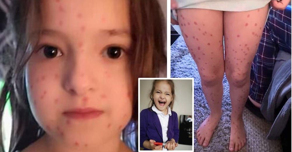 Dibuja marcas rojas en su cuerpo para fingir que tiene varicela y no puede ir al colegio Dibuja marcas rojas en su cuerpo para fingir que tiene varicela y no puede ir al colegio