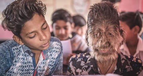 Lo conocen como «el niño lobo»porque su rostro siempre se mantiene cubierto de cabello