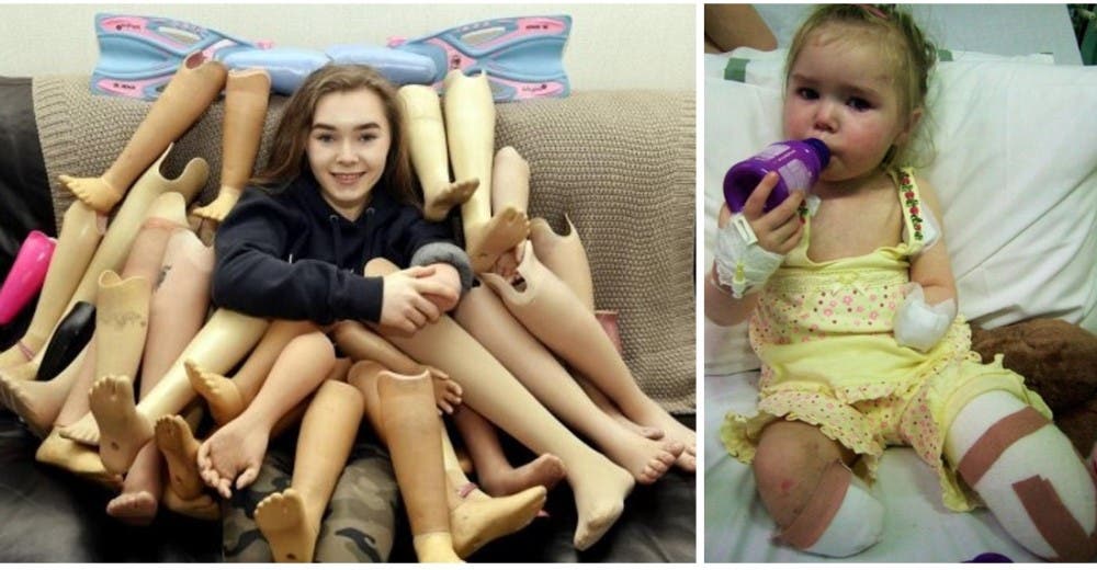 Una valiente joven de 15 años dona sus prótesis después de perder sus piernas y su brazo Una valiente joven de 15 años dona sus prótesis después de perder sus piernas y su brazo