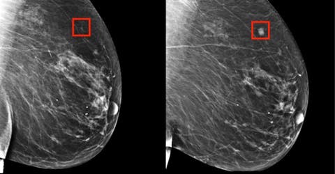 Desarrollan un método que detecta el cáncer de mama hasta con 5 años de anticipación