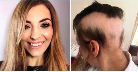 Su boda soñada se convierte en una pesadilla que le costó el 90% de su cabello