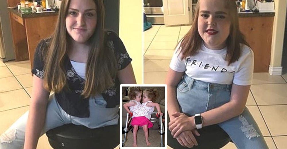 El testimonio de las siamesas que fueron separadas y cada una se quedó con una pierna El testimonio de las siamesas que fueron separadas y cada una se quedó con una pierna