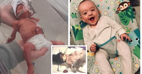 El bebé que nació prematuro pesando 450 gramos sobrevive a la sepsis que sufrió