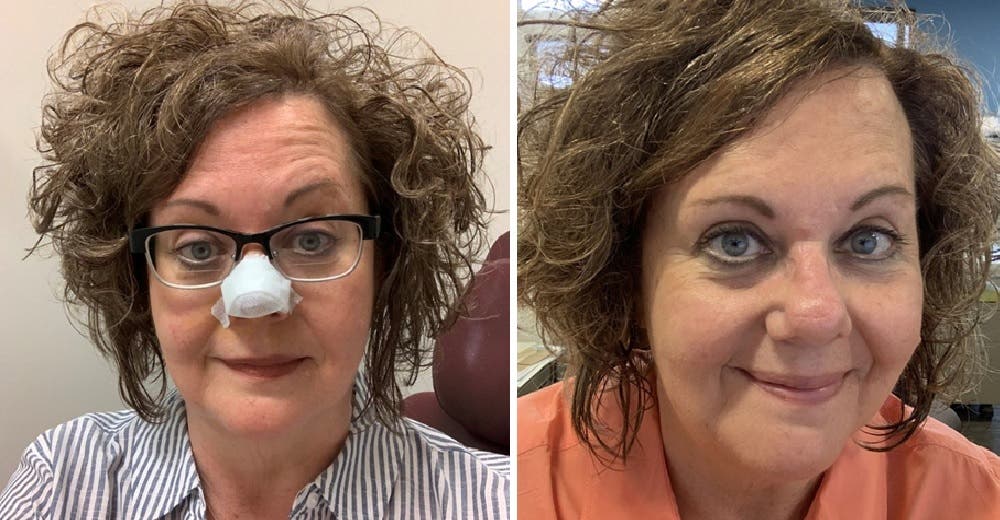 Pasa años expuesta al sol hasta que descubre que una de sus pecas le podía costar la vida Pasa años expuesta al sol hasta que descubre que una de sus pecas le podía costar la vida