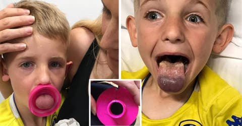 Un niño de 6 años casi pierde la lengua después de que se le atorara una botella de plástico