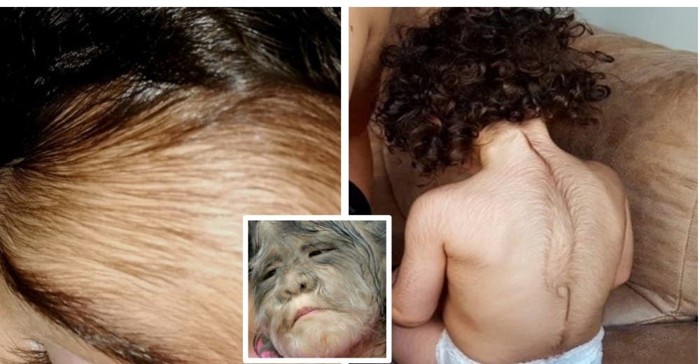 El error de una fábrica de fármacos causa el síndrome del hombre lobo a 17 bebés El error de una fábrica de fármacos causa el síndrome del hombre lobo a 17 bebés