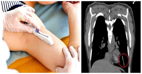 Le colocan un implante anticonceptivo en el brazo y la operan de urgencia – No lo encontraban