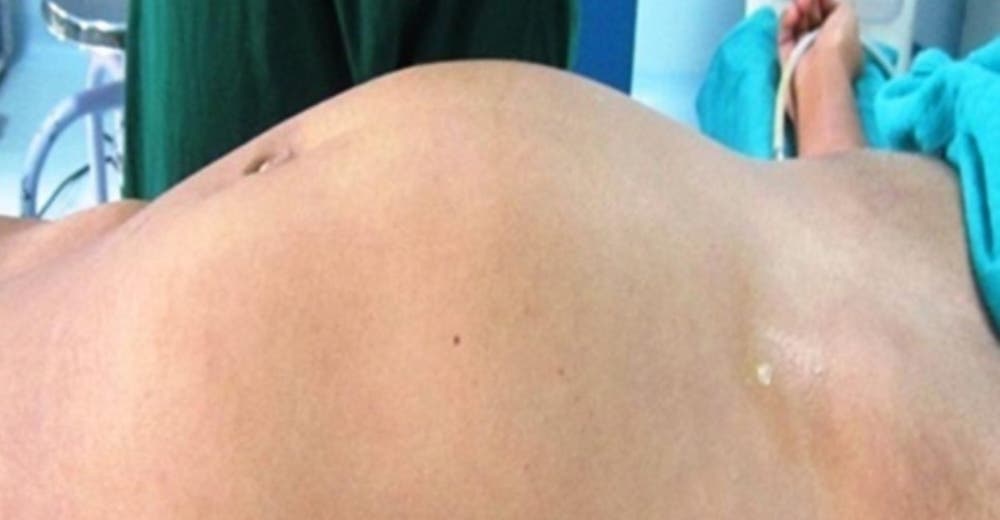 Vive durante 17 años con el feto malformado de su gemelo en el interior de su abdomen Vive durante 17 años con el feto malformado de su gemelo en el interior de su abdomen