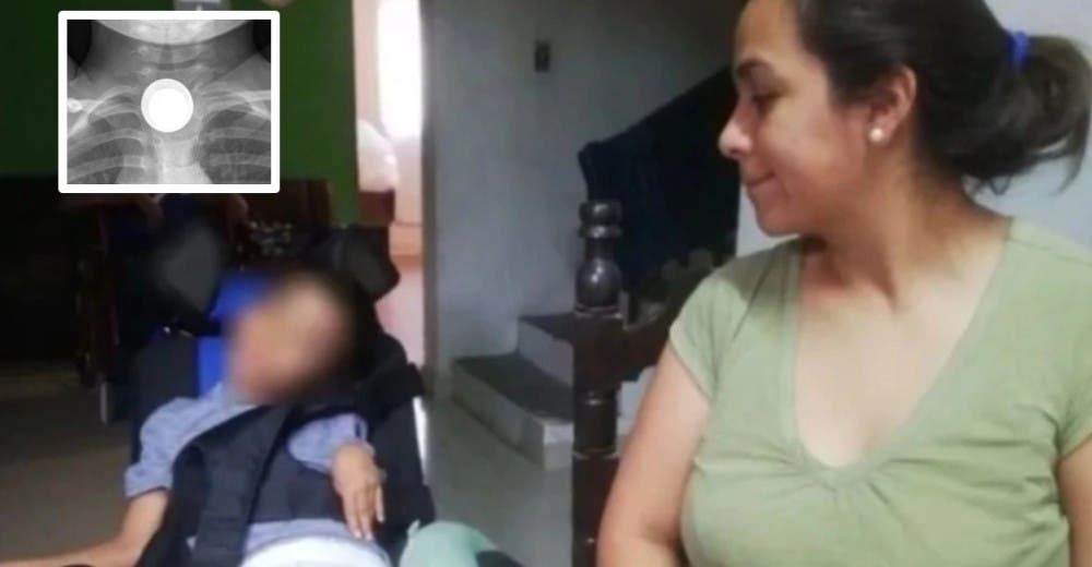 Un niño de 5 años termina con parálisis cerebral por jugar con una pila