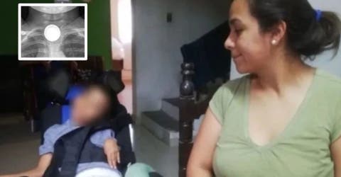 Un niño de 5 años termina con parálisis cerebral por jugar con una pila