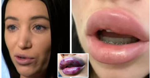 Casi termina ciega después de inyectarse para aumentar el volumen de sus labios