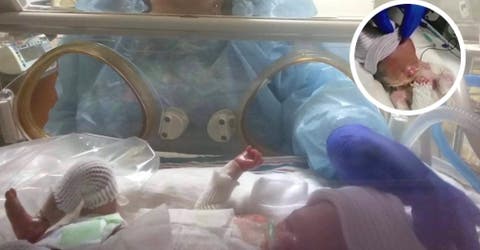 El bebé que nació sin piel sale del hospital después de recibir un trasplante