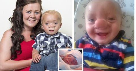 La madre del niño con la “nariz de Pinocho” responde a quienes le dijeron que su hijo no debió nacer