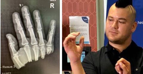Casi pierde la mano y milagrosamente logra mover los dedos tras 24 horas de ser operado