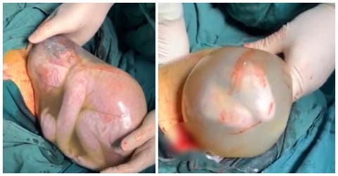 El milagroso parto de un bebé nacido dentro del saco amniótico que no respiró durante 2 minutos