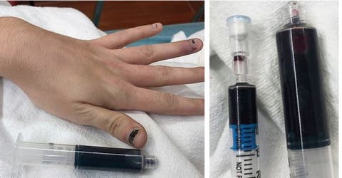 Una mujer termina con la sangre azul tras automedicarse para aliviar un dolor de muela