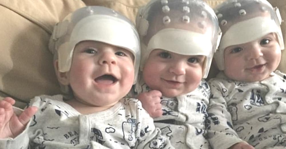 Los trillizos que protagonizan el caso más raro del mundo hacen historia tras ser operados Los trillizos que protagonizan el caso más raro del mundo hacen historia tras ser operados