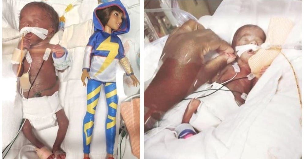 Nace pesando 370 gramos, era más pequeña que una muñeca Barbie y sobrevive de milagro