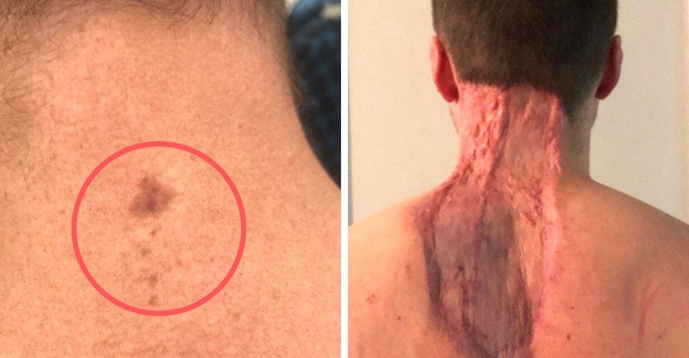 Va al médico por una extraña mancha en su cuello y termina sin 50 centímetros de piel Va al médico por una extraña mancha en su cuello y termina sin 50 centímetros de piel