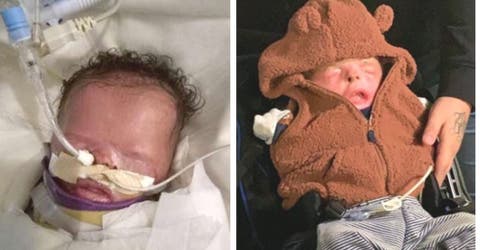 El bebé que nació sin piel logra una milagrosa recuperación