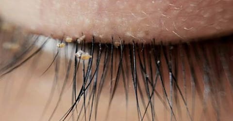 Los médicos alertan sobre la alta incidencia de los piojos en las extensiones de pestañas