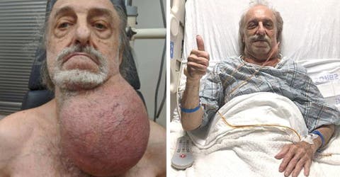 Le extraen el tumor del tamaño de un balón de fútbol que tenía en el cuello y acortaba su vida