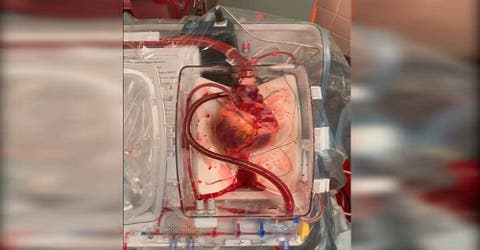 Por primera vez logran revivir un corazón muerto para trasplantarlo con éxito en un paciente