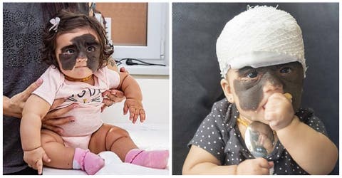La niña que nació con una gran mancha en su rostro ya fue operada – «Fue un milagro de Navidad»
