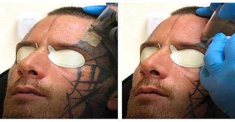 Muestra la terrible consecuencia que sufrió por intentar eliminar los tatuajes de su rostro