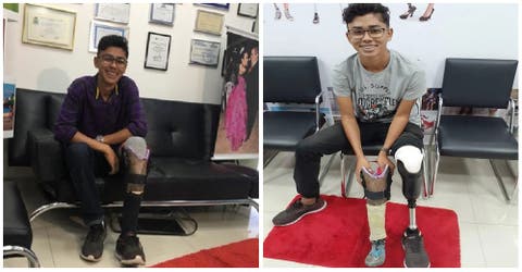 Construyó su prótesis casera por falta de dinero y un empresario le cambia la vida
