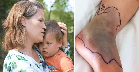 Pensó que a su hijo le había picado una avispa pero su piel comenzó a ponerse azul
