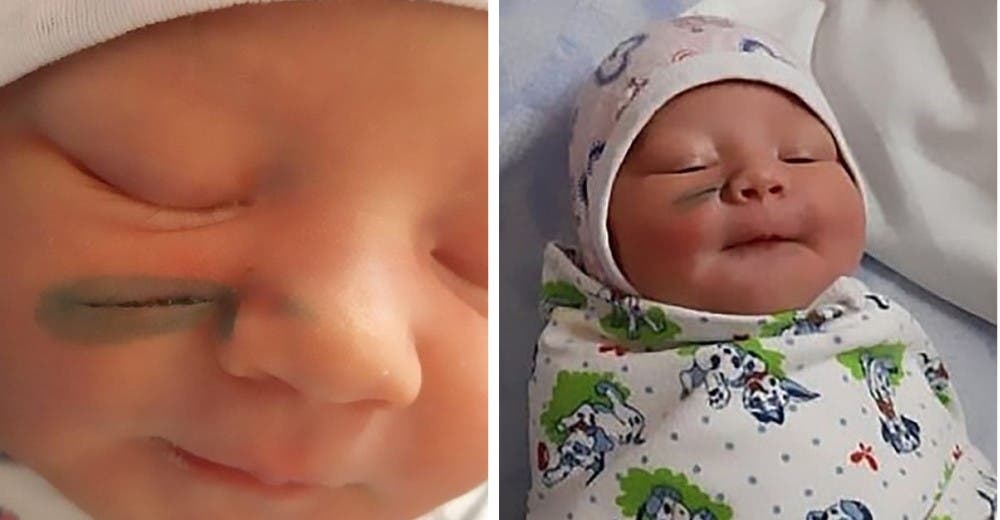 Una bebé sufre una herida en su rostro por un error médico durante la cesárea Una bebé sufre una herida en su rostro por un error médico durante la cesárea