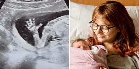 Habla sobre su embarazo la mujer que descubrió que nació con 2 úteros y 2 vaginas