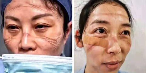 Las imágenes de los médicos que sufren lesiones en sus rostros por luchar contra el coronavirus