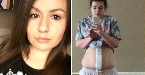 Pensaron que estaba embarazada y descubren que realmente tenía un tumor de 6 kilos