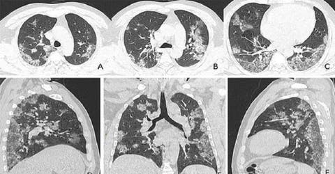 Imágenes de rayos X  de las víctimas de coronavirus revelan el devastador efecto en sus pulmones